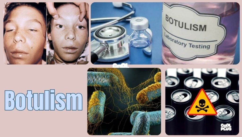 Botulism